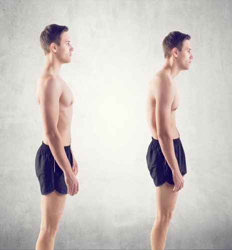 Postural syndrome