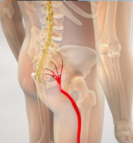 Sciatica